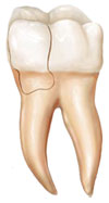 Cracked Tooth Illustration