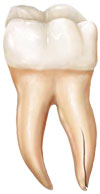 Cracked Tooth Illustration